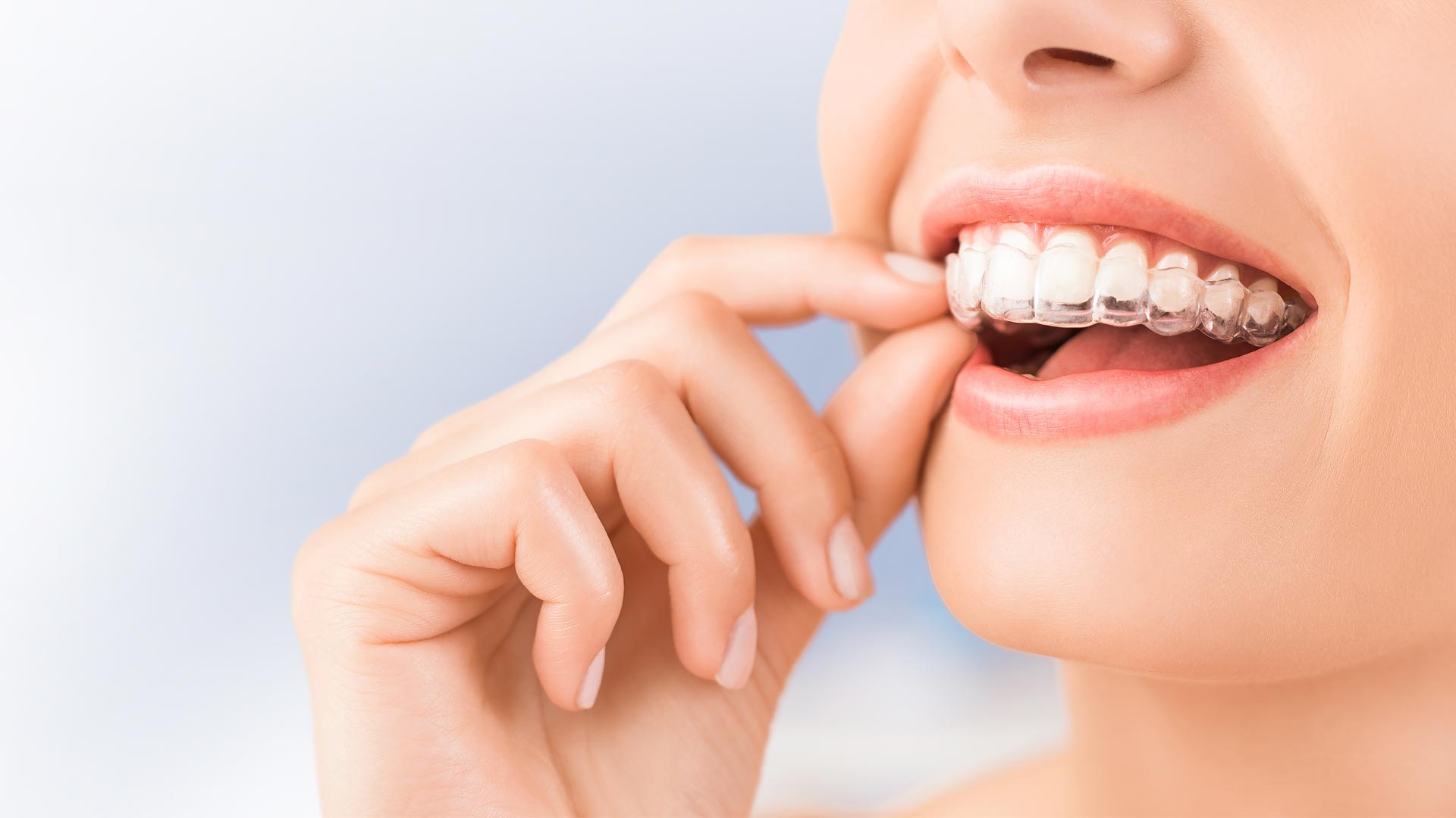 Una mujer poniéndose el alineador invisible en los dientes