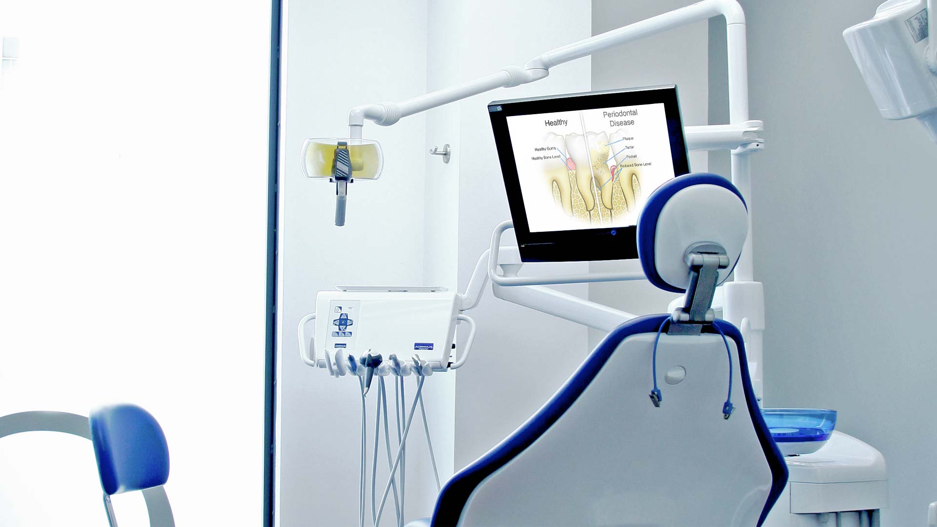 Un gabinete en Clínica Cloe con sillón dental azul y una pantalla que explica las diferencias entre los dientes sanos y la periodontitis
